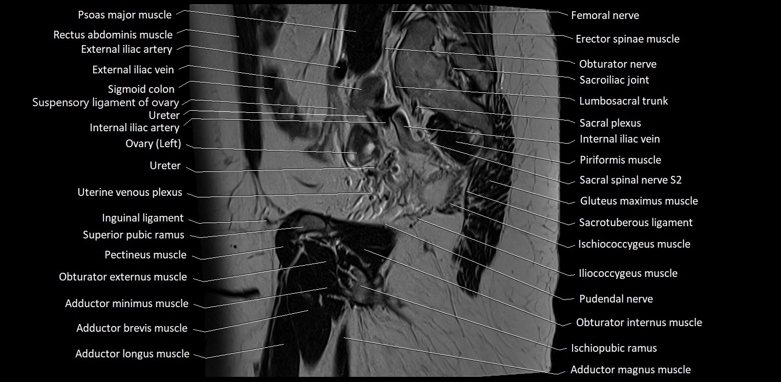 Sagittal cross sectional anatomy of female pelvis (MRI 3T) image 33.webp